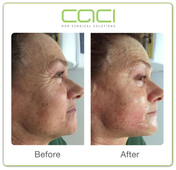 CACI before-and-after facial treatment example