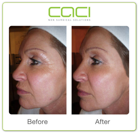 Second CACI before-and-after facial treatment example