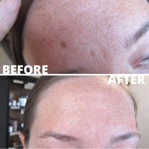 SunSpot forehead Treatment