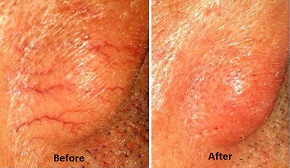 Red Veins Treatment